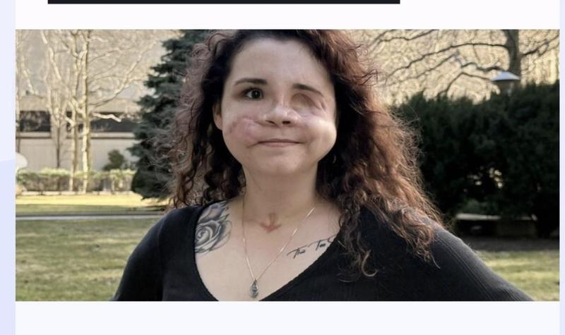 NextGenFace Team Helps Amedy Dewey -who survived a horrific violent trauma.
